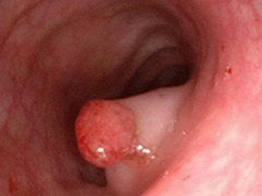 泉州医博治疗直肠息肉的方法有哪些?